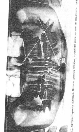 Панорамная рентгенография в ортодонтии
