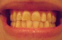 Аномалии положения зубов в трансверзальном направлении
