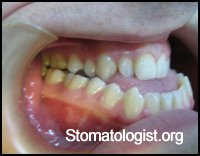Аномалии положения зубов в сагиттальном направлении