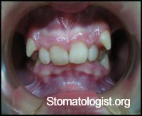 Аномалии положения зубов в вертикальном направлении