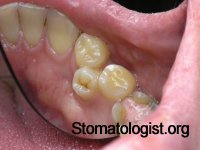 Поворот зуба вокруг его продольной оси и транспозиция зубов
