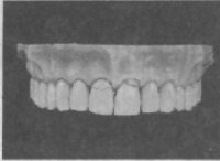 Аномалии зубных дуг в трансверзальном направлении