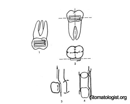 Изготовление индивидуальных колец на опорные моляры, припаивание или приваривание к ним замков-трубок или подбор стандартных колец. 