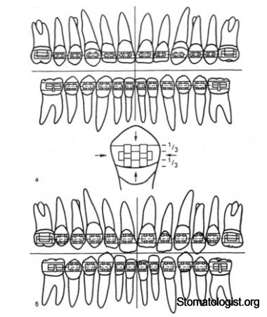 Сочетанные аномалии зубных дуг