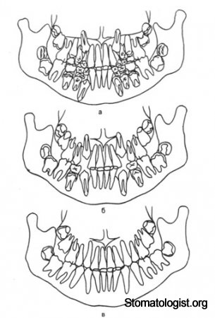 Удаление отдельных зубов по ортодонтическим показаниям. 