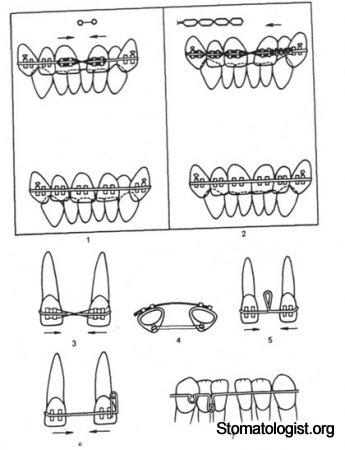 Мезио- или дистопозиция зубов.