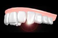 Профилактика и лечение зубного камня