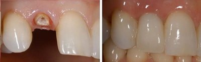 Протезирование передних зубов коронками
