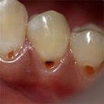 Эрозия зубов и болезни пищевого поведения