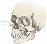 Горизонтальные переломы верхней челюсти