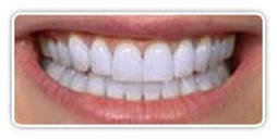 Отбеливание и причины изменения цвета зубов