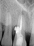 Наиболее частые области закрытия перфораций корня зуба