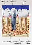 Имплантация зубов при неблагоприятных анатомических условиях