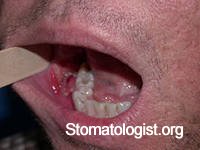 Лучевые поражения полости рта