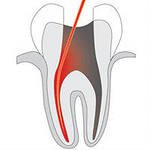 Удаление нерва зуба. Особенности удаления зубного нерва