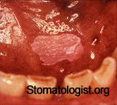 Центральная гигантоклеточная опухоль в полости рта