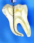 Пломбирование канала корня зуба