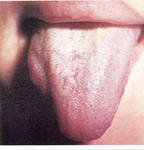 Грибковые заболевания слизистой полости рта