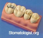 Что опасного в стоматологических пломбах?