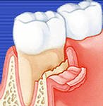 Одонтогенный челюстной остеомиелит