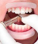 Ортодонтическая сепарация зубов