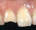 Сколы зубов или выбитые зубы